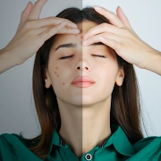 Pimple blemish remover